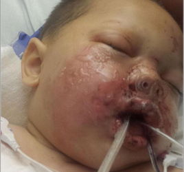 Bounkham Phonesavah was severely injured.  Now they don't want to pay his medical bills.